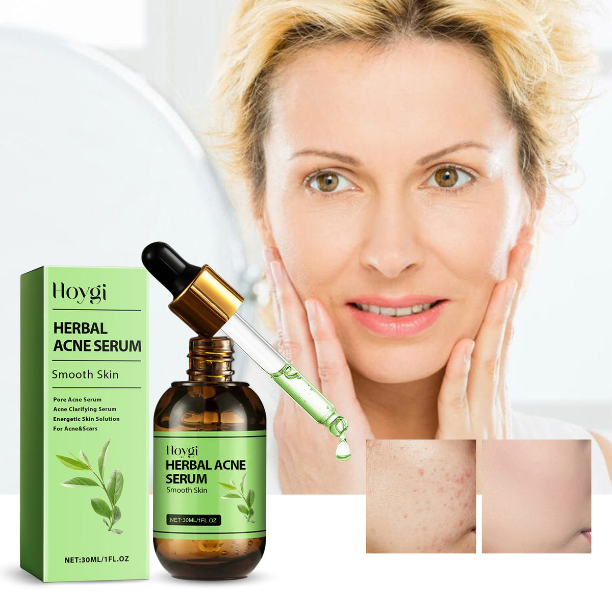 Herbal Acne Serum, Reduce Acne Pimples With A Comprehensive Moisturizing Moisturizer